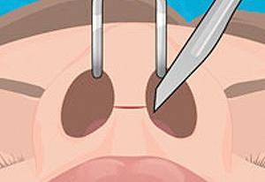 CIRURGIA NO NARIZ ! (OPERATE NOW) - nose surgery 